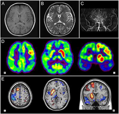 Corticostriatal Hypermetabolism in Moyamoya Disease-Induced Hemichorea: Two Case Reports and a Literature Review